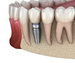 Dental implant