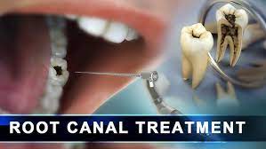 Root canal treatment